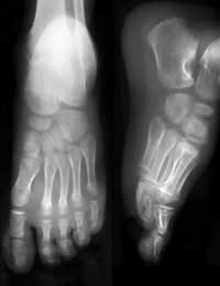 Osteoarthritis; Rheumatoid Arthritis;