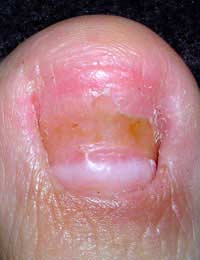 Fungal Infection; Athlete's Foot; Tinea