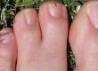 Webbed Toes and Treatment