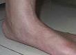 Is There Any Way to Correct Flat Feet?