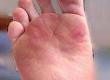 How to Minimise the Risk of Blisters