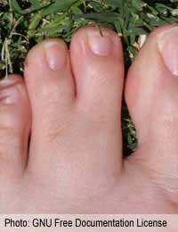 Common Foot Problems