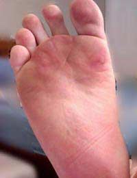 Blisters Risk Painful Feet Shoes