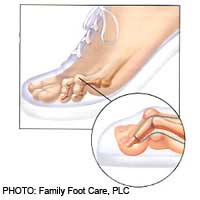 Hammer Toes; Deformity; Joints; Corns;