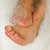 In-growing Toenails