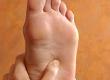 Flat Feet