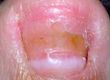 Fungal Infections of the Foot and Toenail