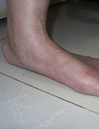 Flat Feet Over Pronation Tendons Shin